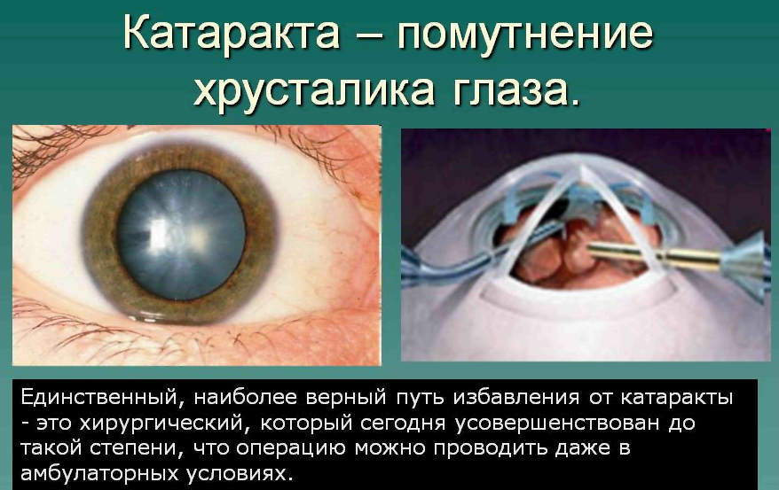 Катаракта | lemur59.ru