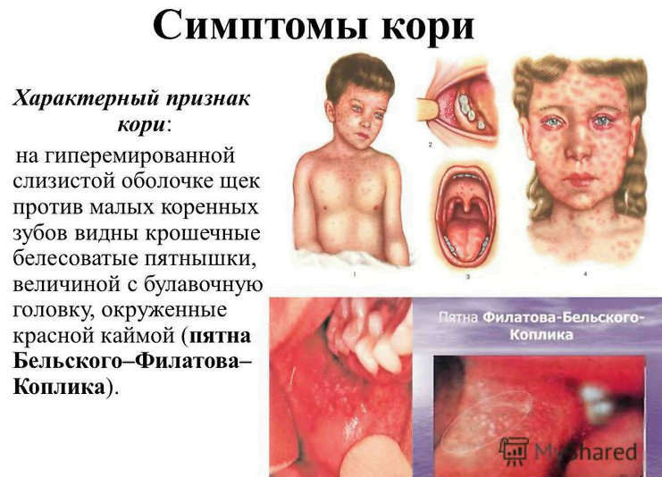 КОРЬ-ПРОФИЛАКТИКА, ПРИЗНАКИ, ЛЕЧЕНИЕ